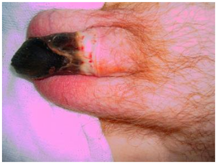 Figure 4: Penile necrosis caused by the prolonged constrictor effect of the adhesive binding band of the condom catheter.
