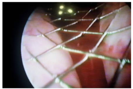 Figure 5: Permanent prostatic stent inserted into the male urethra.