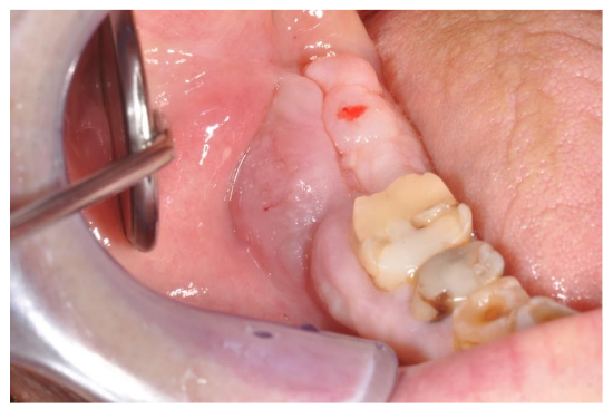 Image 2. Intraoral aspect of the exophytic lesion at the level of the right mandible: in the middle a groove allows to approach the bone lesion.