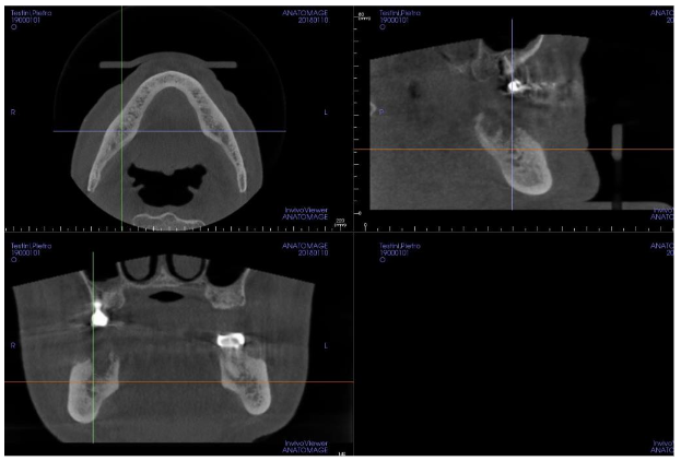 Image 4. Cone Beam Computer Tomography before the treatment showing the proximity of the lower alveolar nerve on the right side and the pathologic bone, condition that induced radiated pain from the mandible up to the right ear.
