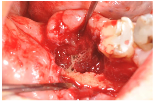 Image 5. After the removal of the soft pathologic tissue the deepest part of the lesion appeared with necrotic bone mixed with a tissue rich in small vessels.