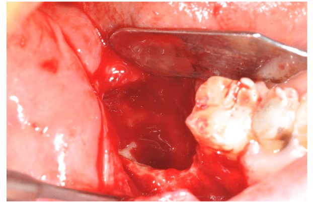 Image 6. Complete removal of the bone lesion. The exposition of healthy bone is identified by a good bleeding.