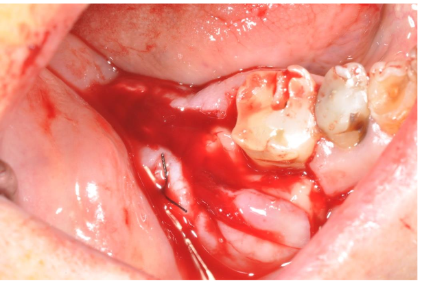 Image 7. Filling of the cavity with PRGF-Endoret membranes that induced more bleeding.