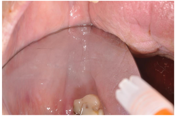 Image 9. Follow-up after 4 months: the lesion appeared completely healed (the image has been taken using a intraoral mirror).