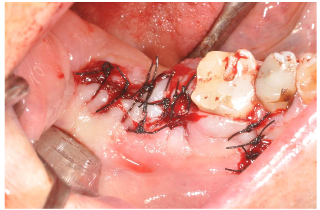 Image 8. Complete closure of the cavity with the sutures.