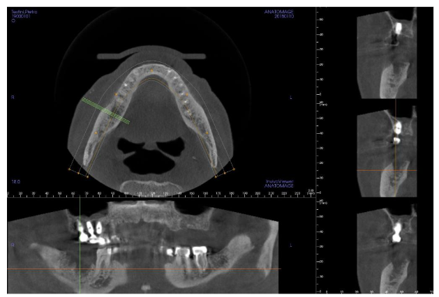 Image 3. Cone Beam Computer Tomography before the treatment showing the extension of the bone lesion.