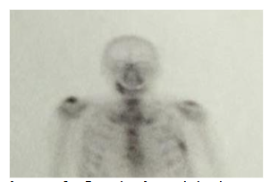 Image 1. Detail of total body scintigraphy for the evaluation of prostate cancer metastases.