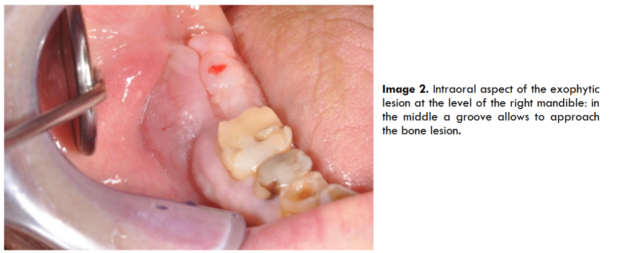 Intraoral aspect of the exophytic lesion at the level of the right mandible: in the middle a groove allows to approach the bone lesion.