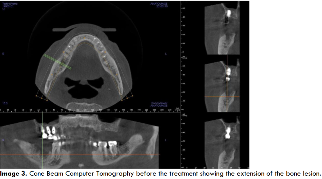 Cone Beam Computer Tomography before the treatment showing the extension of the bone lesion.