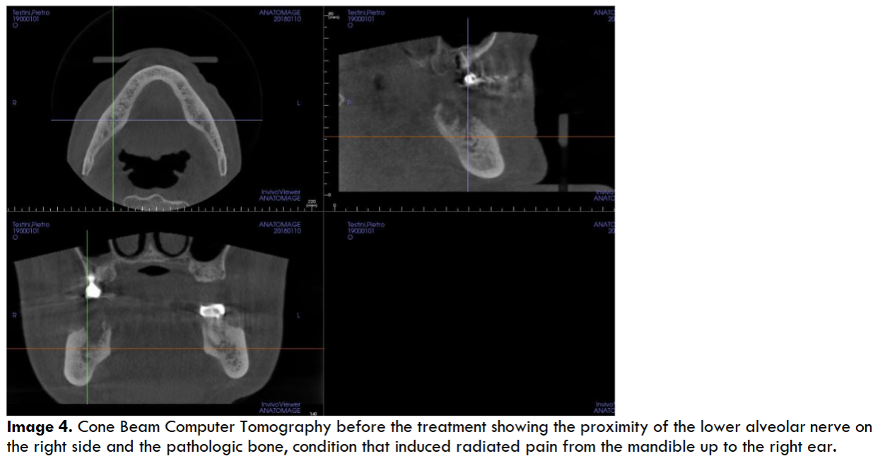Cone Beam Computer Tomography before the treatment showing the proximity of the lower alveolar nerve on the right side and the pathologic bone, condition that induced radiated pain from the mandible up to the right ear.
