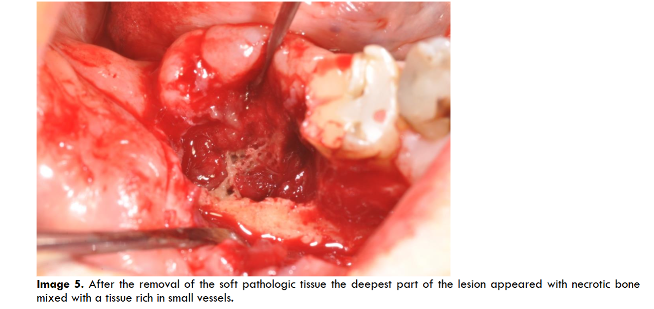 After the removal of the soft pathologic tissue the deepest part of the lesion appeared with necrotic bone mixed with a tissue rich in small vessels.