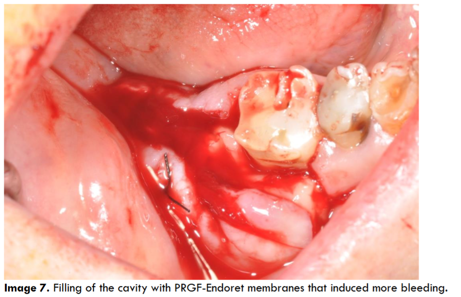 Filling of the cavity with PRGF-Endoret membranes that induced more bleeding.