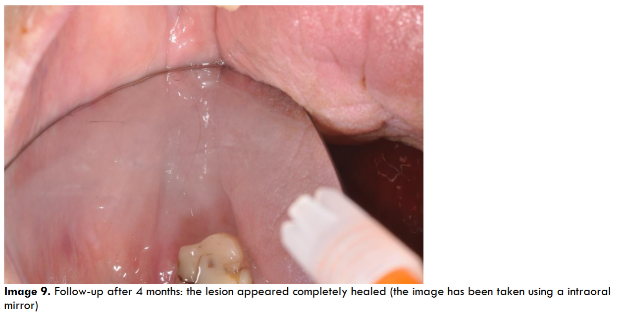Follow-up after 4 months: the lesion appeared completely healed (the image has been taken using a intraoral mirror).