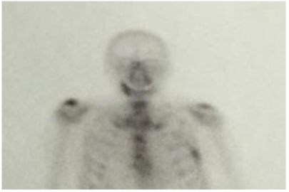 Detail of total body scintigraphy for the evaluation of prostate cancer metastases.