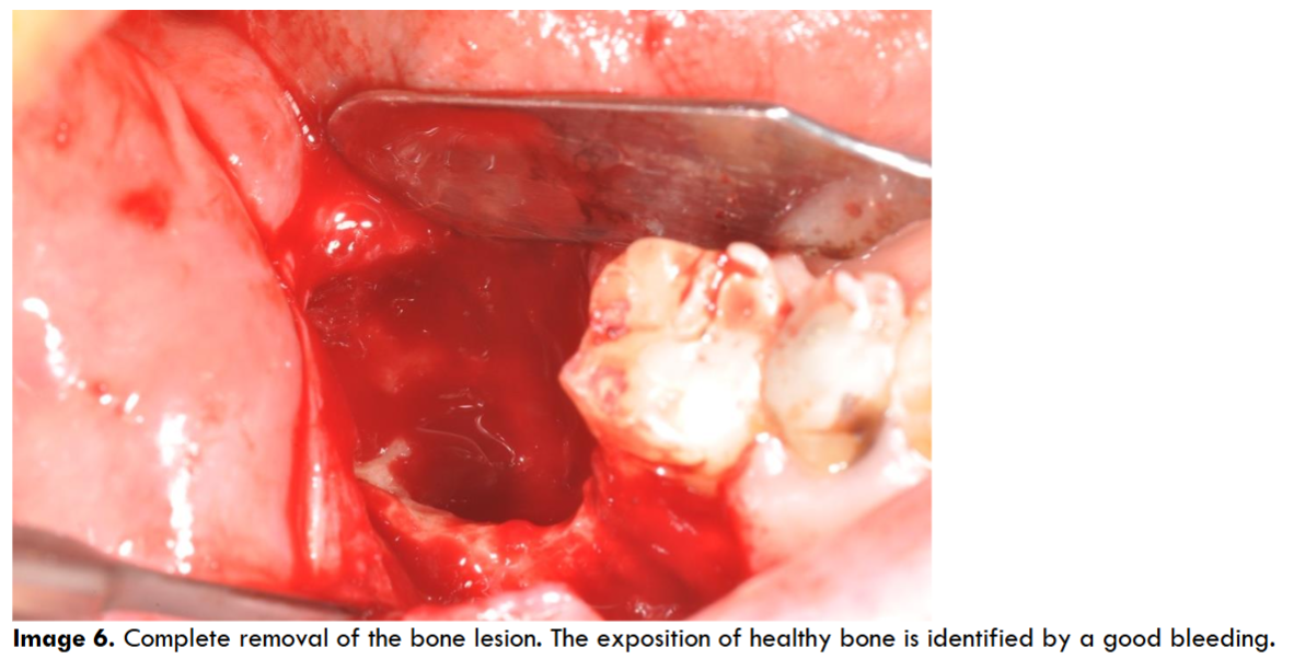 Complete removal of the bone lesion. The exposition of healthy bone is identified by a good bleeding.