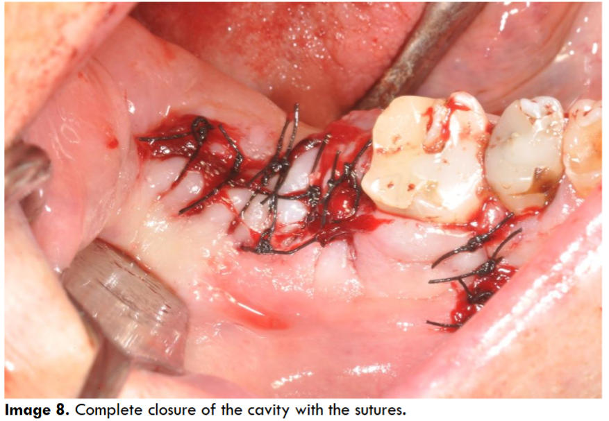 Complete closure of the cavity with the sutures.