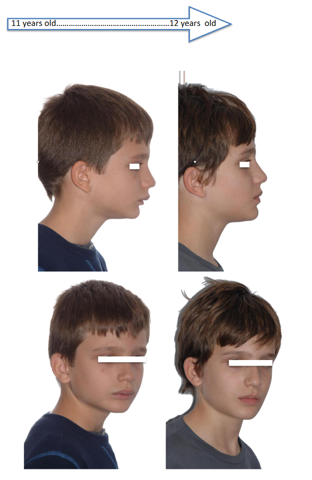 CLINICAL CASE Nº 1: 11-year-old patient treated with POT® appliance, for 8 months.