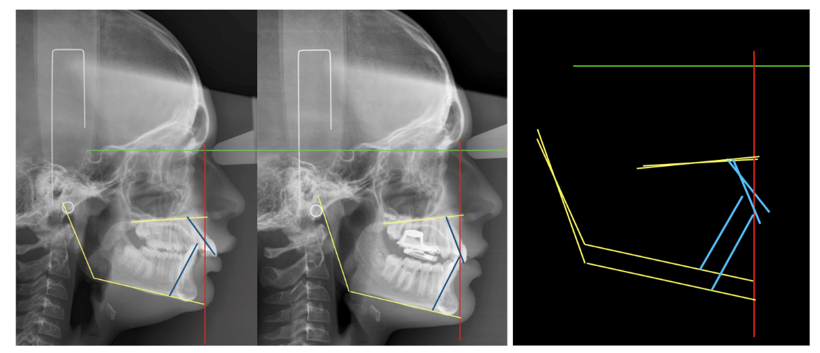 Case Nº 1: 11-year-old patient, treated with POT® appliance, for 8 months. Lateral cranial X-ray, with cephalostat and calibrated. Superimpositions in the Interclinoid plane and perpendicular from Nasion.