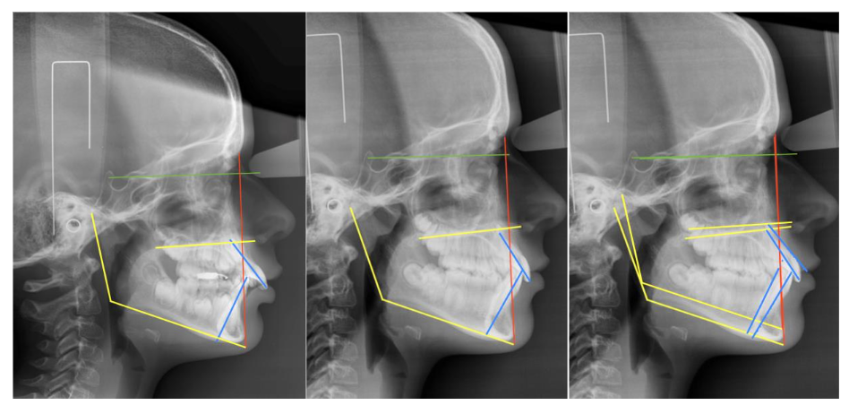 Case Nº 2: Frontal facial photos. From 9/4 to 13/2 years of age.