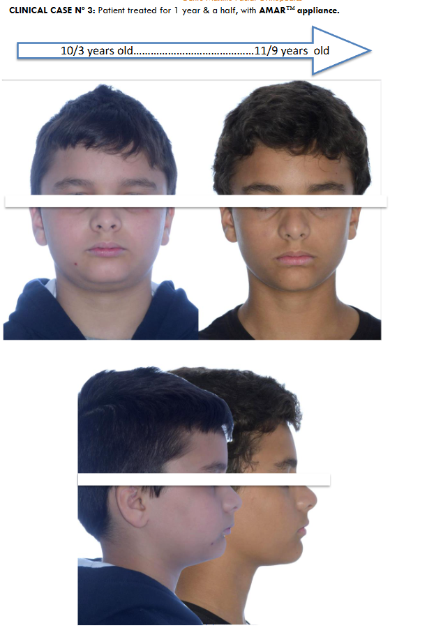 Case Nº 3: Lateral cranial X-ray, with cephalostat and calibrated. Superimpositions in the Interclinoid plane, and perpendicular from Nasion. Patient nº 3, treated 1 year & a half with AMAR™ appliance.