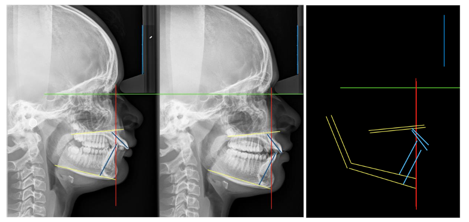 Case Nº 3: Lateral cranial X-ray, with cephalostat and calibrated. Superimpositions in the Interclinoid plane, and perpendicular from Nasion.
