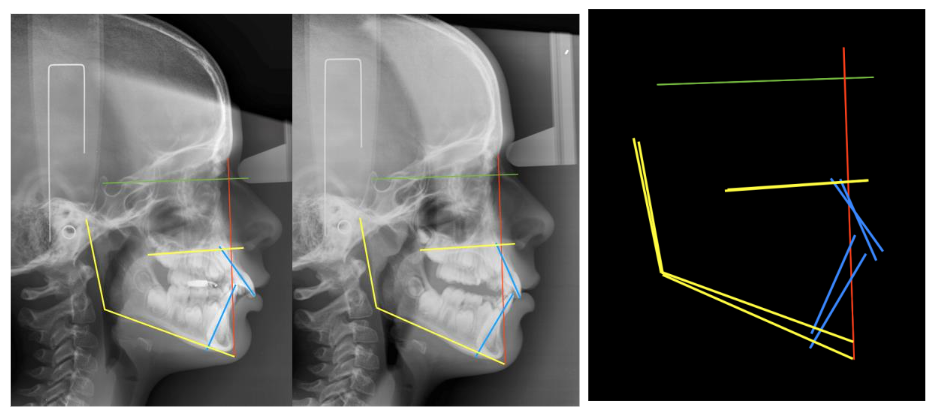 Case Nº 2: Patient treated with POT® appliance for 7 months. Lateral cranial X-ray, with cephalostat and calibrated. Superimpositions in the Interclinoid plane, and perpendicular from Nasion.
