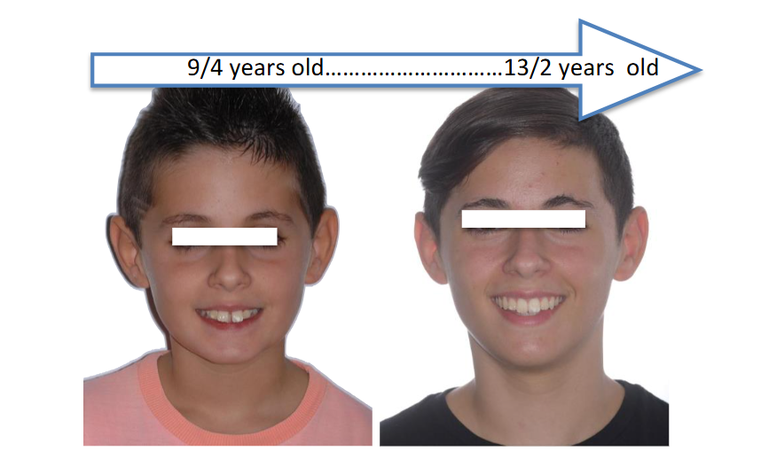 CLINICAL CASE Nº 3: Patient treated for 1 year & a half, with AMAR™ appliance.