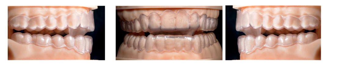 Fig. 1.- AMAR in the articulator. Mandibular advancement determines an anterior and posterior infraocclusion, in relation to the physiological condylar trajectory, and the articular eminence.