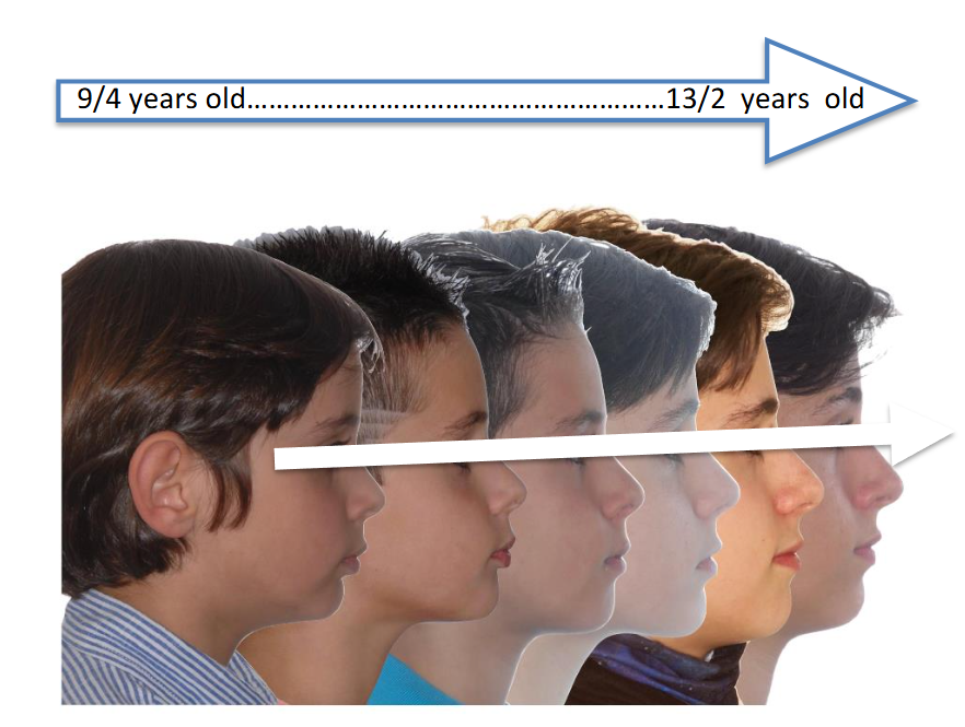 CLINICAL CASE Nº 2: Patient treated in three phases. At 9/4 years with POT® for 7 months. At 10/1 years with ANAM® for 16 months. At 11/8 years with Invisalign™ for 18 months.
