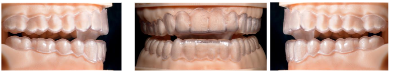 Fig 1.- AMAR in the articulator. Mandibular advancement determines an anterior and posterior infraocclusion, in relation to the physiological condylar trajectory, and the articular eminence.