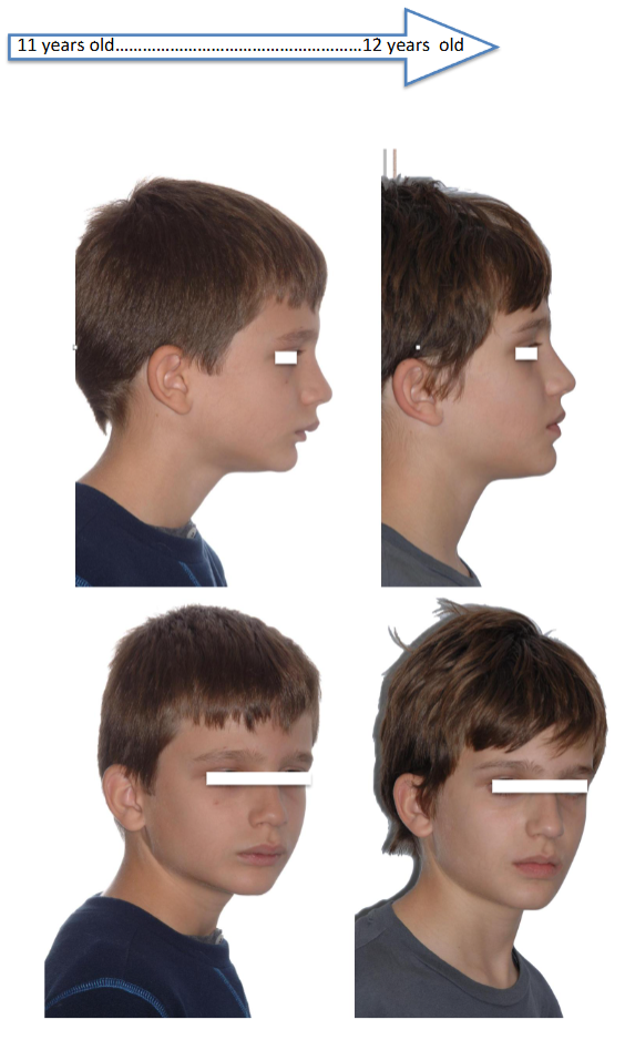CLINICAL CASE Nº 1: 11-year-old patient treated with POT® appliance, for 8 months. 11 years old - 12 years old