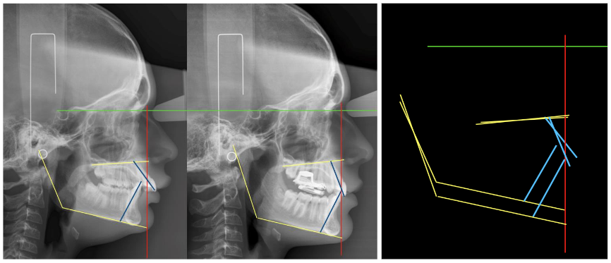 Case Nº 1: 11-year-old patient, treated with POT® appliance, for 8 months. Lateral cranial X-ray, with cephalostat and calibrated. Superimpositions in the Interclinoid plane and perpendicular from Nasion.
