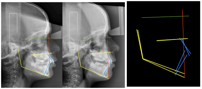 Case Nº 2: Patient treated with POT® appliance for 7 months. Lateral cranial X-ray, with cephalostat and calibrated. Superimpositions in the interclinoid plane and perpendicular from Nasion.