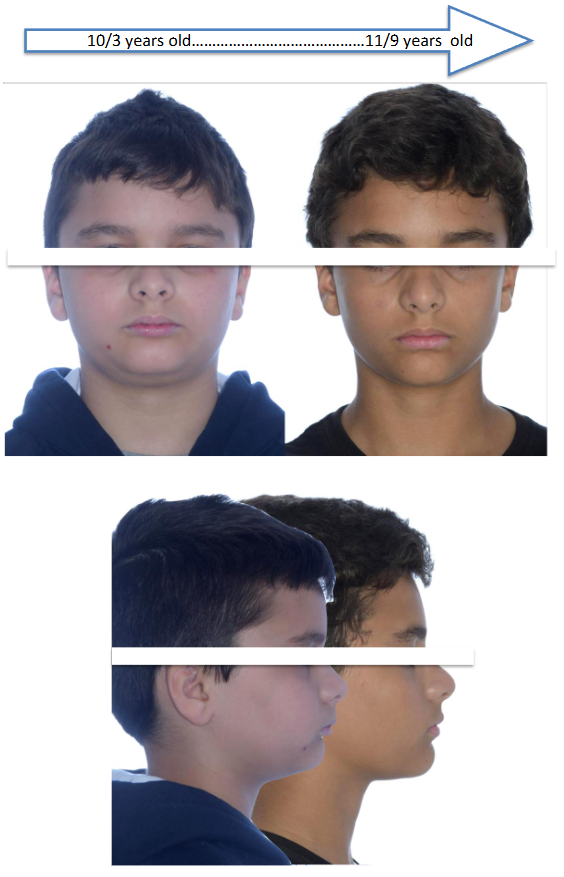 Case Nº 3: Lateral cranial X-ray, with cephalostat and calibrated. Superimpositions in the Interclinoid plane, and perpendicular from Nasion. Patient nº 3, treated 1 year & a half with AMAR™ appliance.