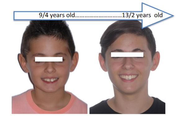 CLINICAL CASE Nº 3: Patient treated for 1 year & a half, with AMAR™ appliance. 10/3 years old - 11/9 years old