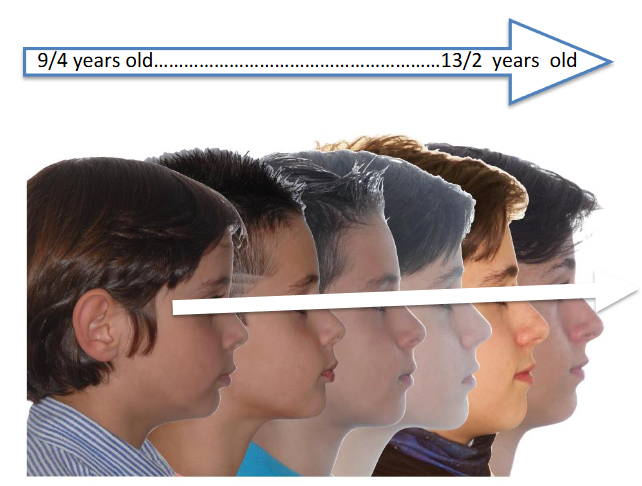 CLINICAL CASE Nº 2: Patient treated in three phases. At 9/4 years with POT® for 7 months. At 10/1 years with ANAM® for 16 months. At 11/8 years with Invisalign™ for 18 months. 9/4 years old - 13/2 years old