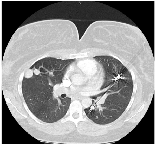 Figure 3: Computed tomography scan following coil placement following acute PAVM rupture in the postpartum period.