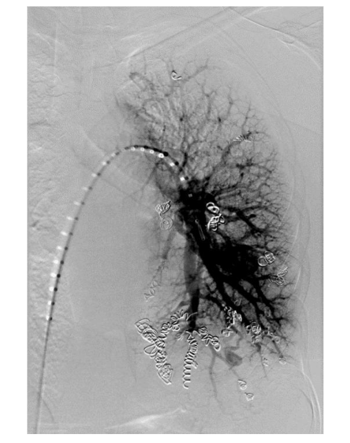 Figure 1: Interventional radiology coil placement into left sided AVMs.