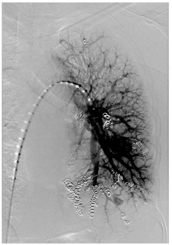 Figure 1: Interventional radiology coil placement into left sided AVMs.