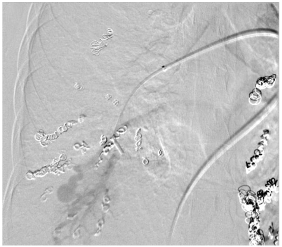 Figure 2: Interventional radiology coil placement into right sided AVMs.