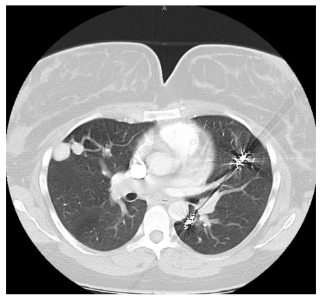 Figure 3: Computed tomography scan following coil placement following acute PAVM rupture in the postpartum period.
