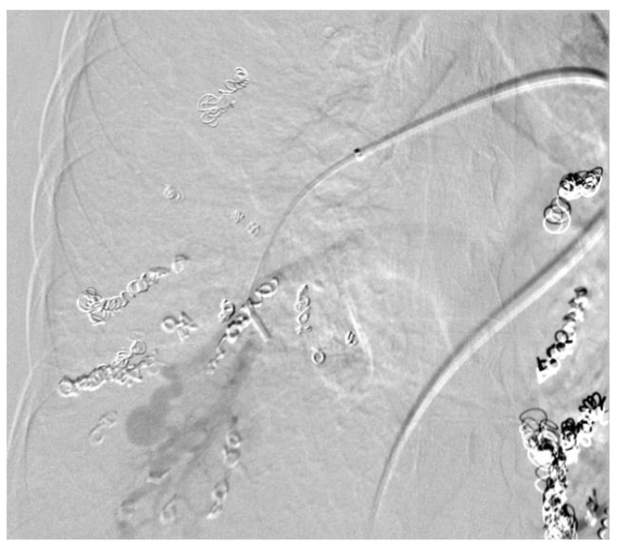 Figure 2: Interventional radiology coil placement into right sided AVMs.