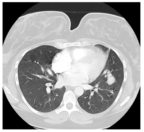 Figure 4: Computed tomography scan following coil placement following acute PAVM rupture in the postpartum period.