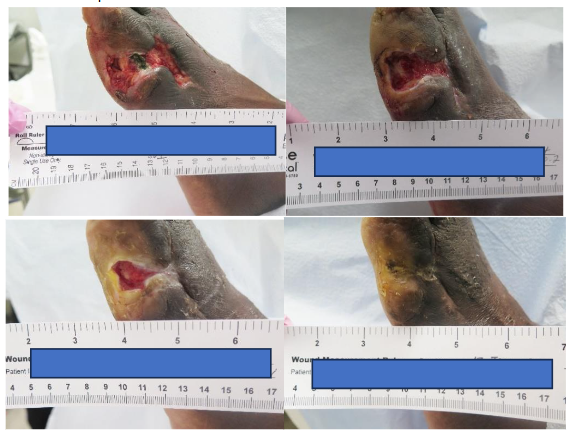 Chronic DFU with Exposed Tendon