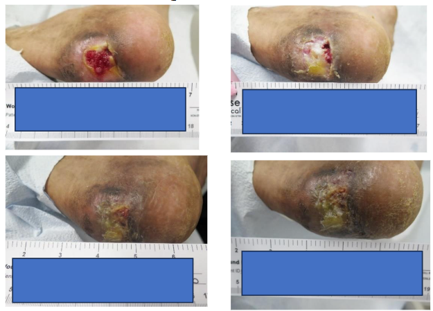 Chronic Diabetic Foot Ulcer in a High-Risk, Nonadherent Patient