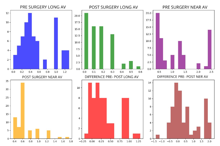 Figure 2. Data distribution by histograms for pre-surgical distance and near visual acuity. On the X axis: LogMAR and Y axis: number of eyes.