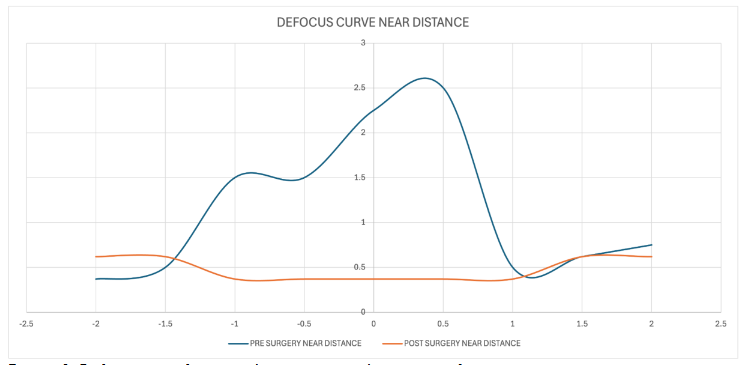 Figure 6. Defocus curve for near-distance vision, showing significant postoperative improvement in near visual acuity and reduction in sensitivity to defocus.