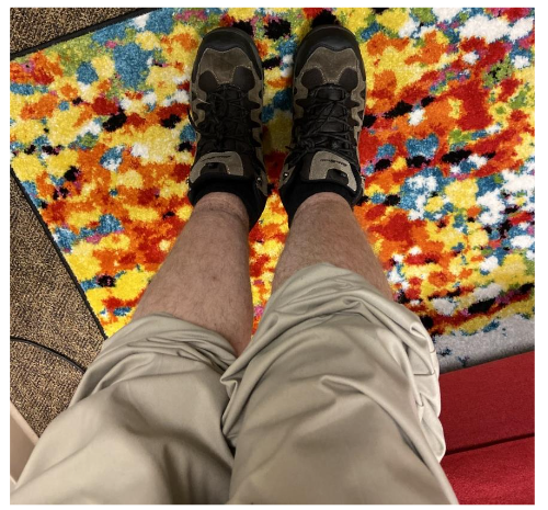 Pitting lower extremity edema observed on Nov. 30<sup>th</sup>, 2021, approximately 13 days after mRNA-1273 COVID-19 vaccine injection.