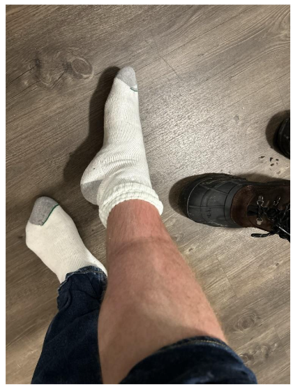 Electrocardiogram at initial clinical evaluation (August 1<sup>st</sup>, 2023) indicated diffuse ST elevation.