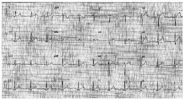 Electrocardiogram at approximately 7 months following initiation of rapamycin treatment (October 16<sup>th</sup>, 2024) demonstrated complete ST elevation resolution.